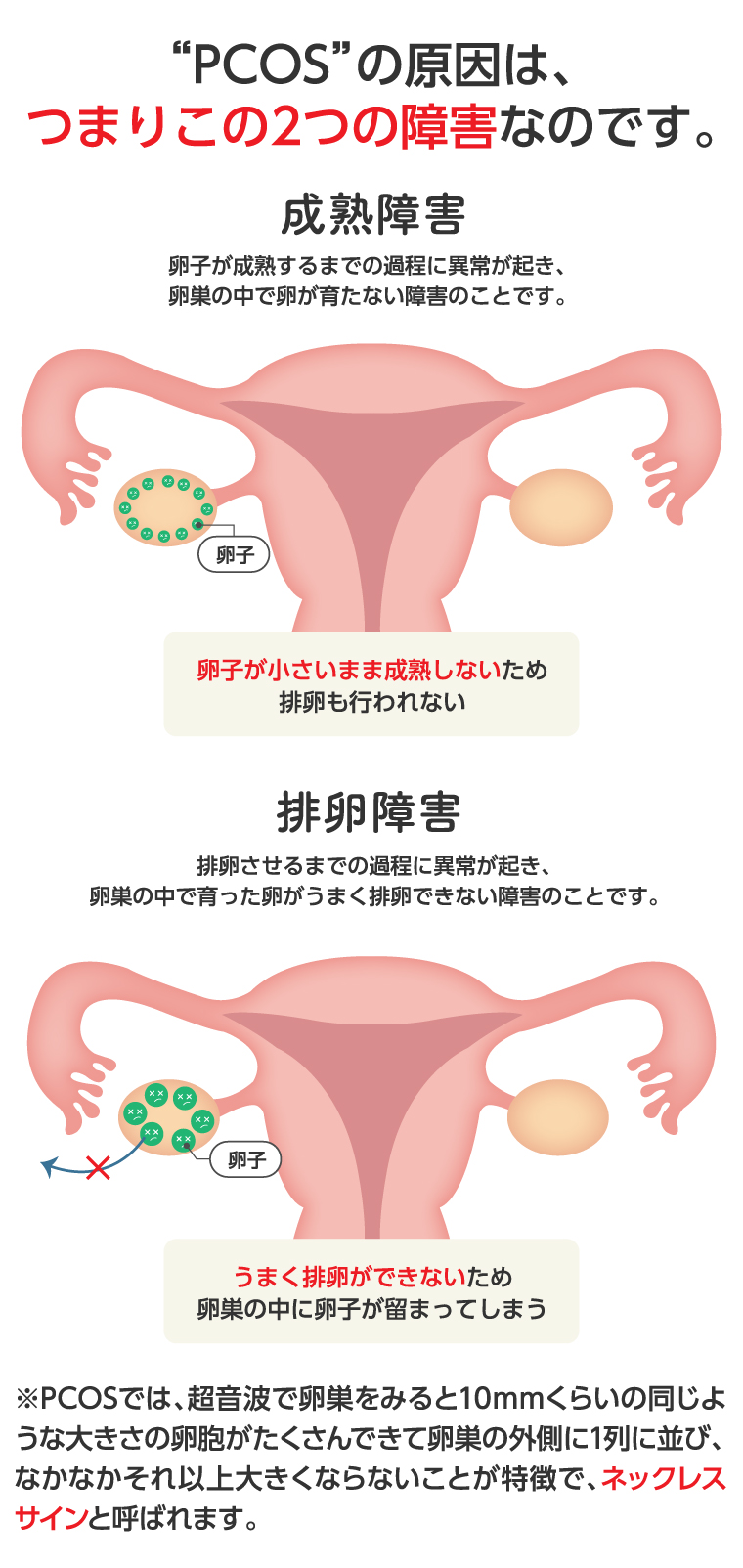 多 嚢胞 性 卵巣 症候群 流産 し やすい