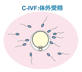 体外受精